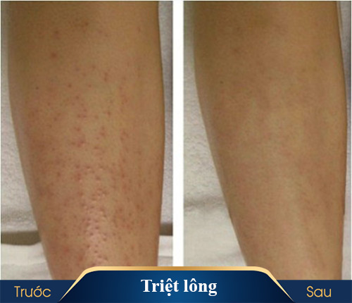 hình ảnh triệt lông kangnam 1