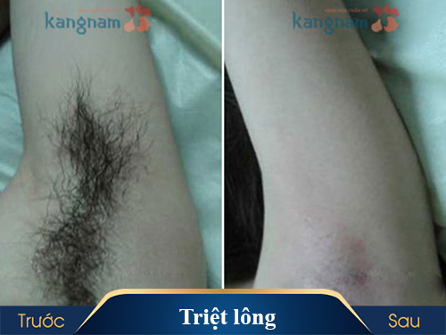 Hình ảnh thực tế của khách hàng trước và sau triệt lông tại Kangnam