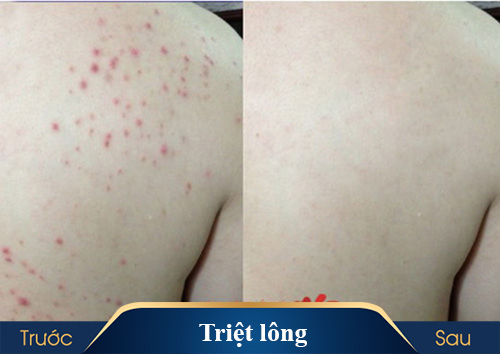 hình ảnh triệt lông kangnam 2