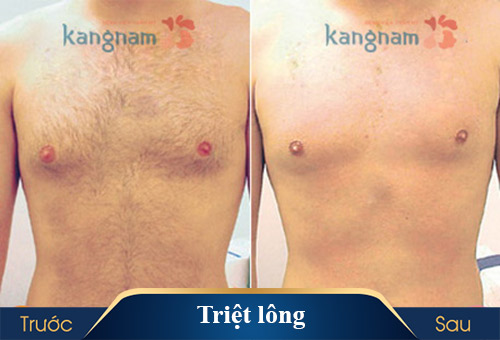 hình ảnh triệt lông kangnam 3
