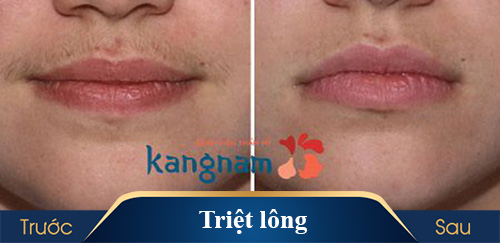 hình ảnh triệt lông kangnam 3