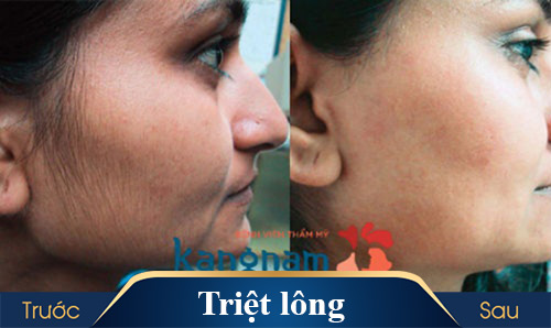 hình ảnh triệt lông kangnam 3