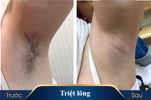 hình ảnh triệt lông kangnam 5