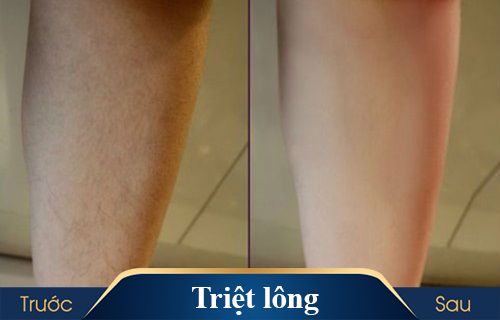 hình ảnh triệt lông kangnam 7