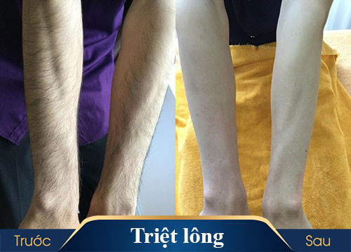 hình ảnh triệt lông kangnam 4