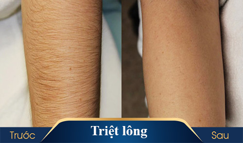 hình ảnh triệt lông kangnam 9