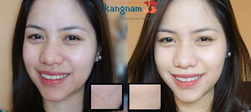 Kết quả sau một liệu trình tắm trắng tại Kangnam quy trình tắm trắng tại spa, quy trinh tam trang tai tham my vien, quy trinh tam trang toan than