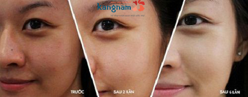 Da sáng bật tone sau mỗi liệu trình tắm trắng quy trình tắm trắng toàn thân, các bước tắm trắng, liệu trình tắm trắng