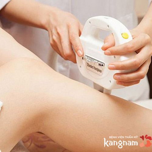 Diode laser – Giải pháp triệt lông chân vĩnh viễn – Hiệu quả – Không tái phát