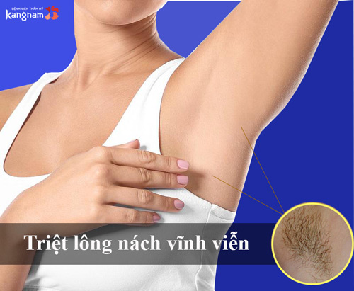 Cách triệt lông nách vĩnh viễn 2 trong 1: Triệt lông và trị thâm nách 500k