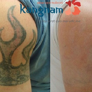 Hình ảnh khách hàng trước và sau khi xóa xăm tại Kangnam