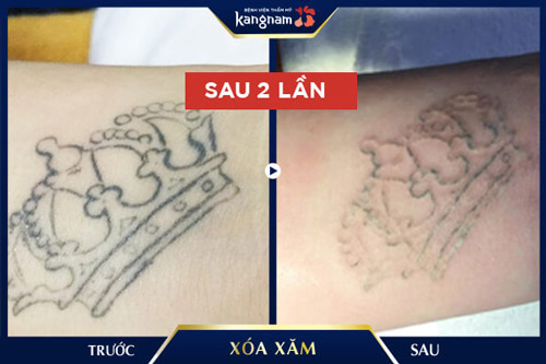xóa xăm bằng laser 
