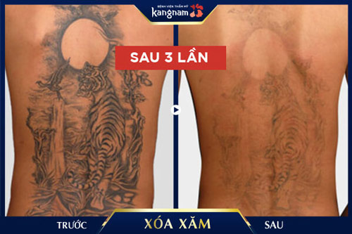 xóa hình xăm lớn 