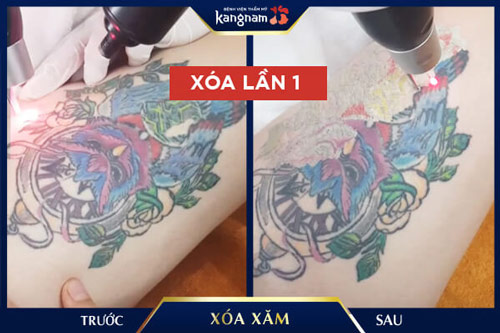 xóa hình xăm màu 
