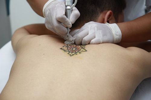 xóa xăm bằng kim