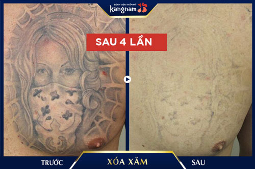 xóa xăm lớn