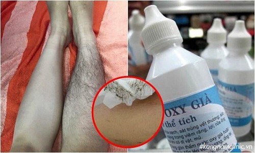 cách tẩy lông chân tại nhà bằng oxy già