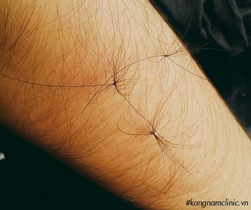 tẩy lông vùng kín bằng oxy già