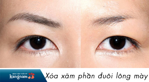 xóa xăm lông mày bao nhiêu tiền