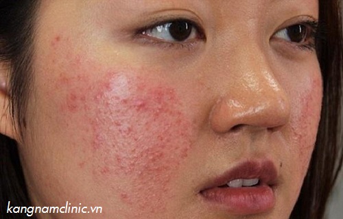 Tẩy lông mặt bằng mỡ trăn không đúng cách có thể gây hại cho da triệt lông mặt bằng mỡ trăn