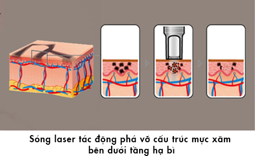 tẩy lông mày bằng laser