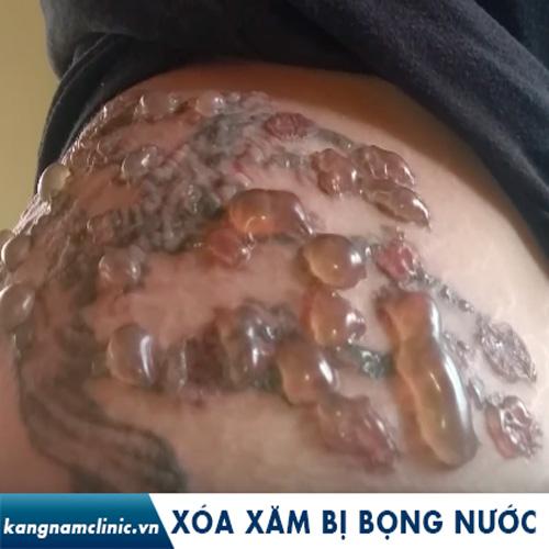 Xóa xăm bị bọng nước có sao không? Những biểu hiện thường gặp sau xóa xăm