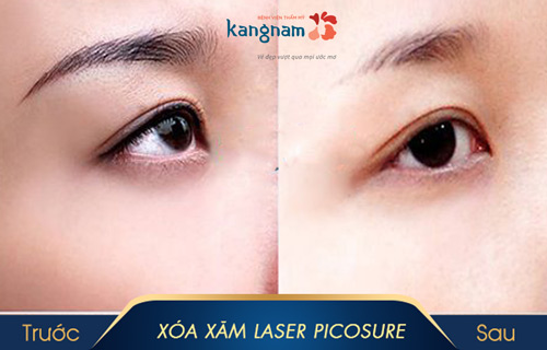 xóa chân mày bằng laser 